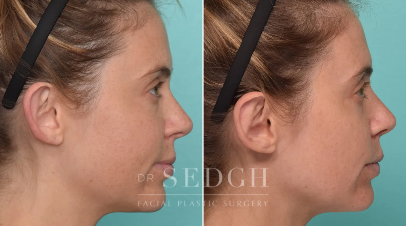 Patient 321 after Ear Pinning Surgery, view 1