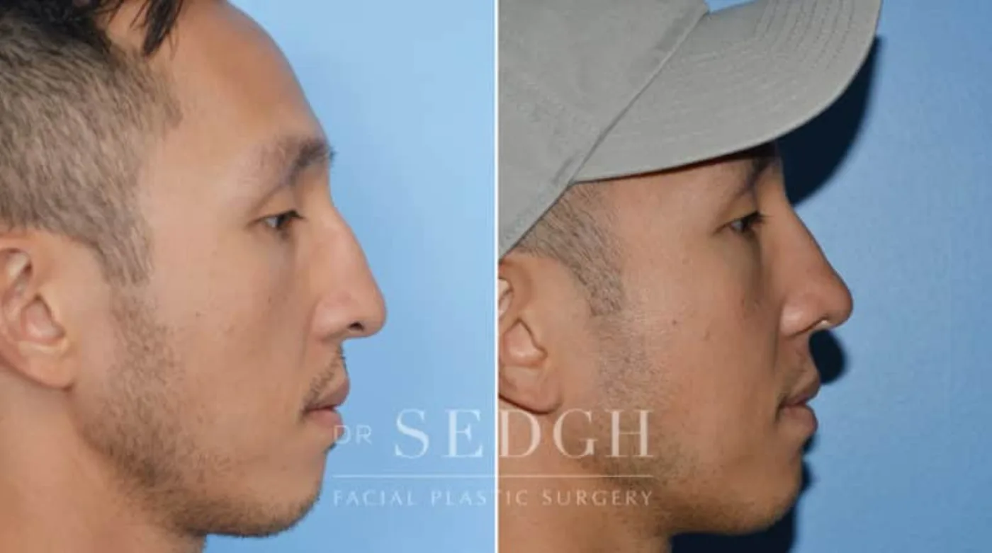 Patient 4 after Middle Eastern Rhinoplasty, view 1