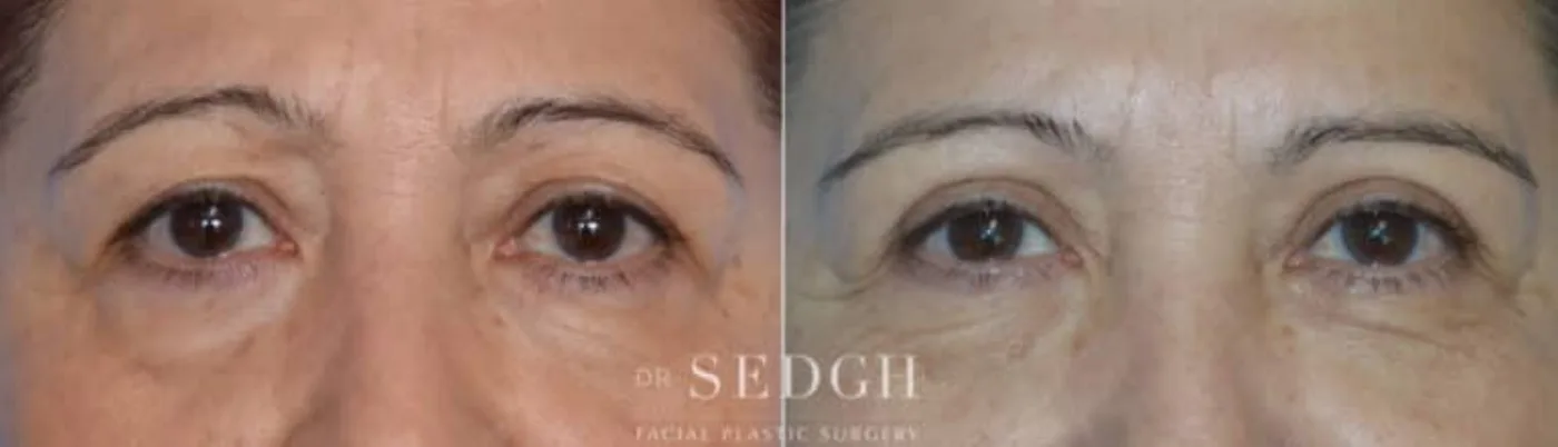 Patient 5 before Upper Blepharoplasty, view 1