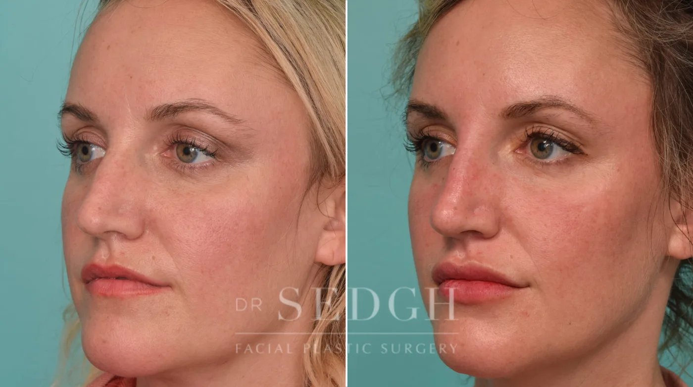 Patient 221 before Liquid Rhinoplasty, view 1