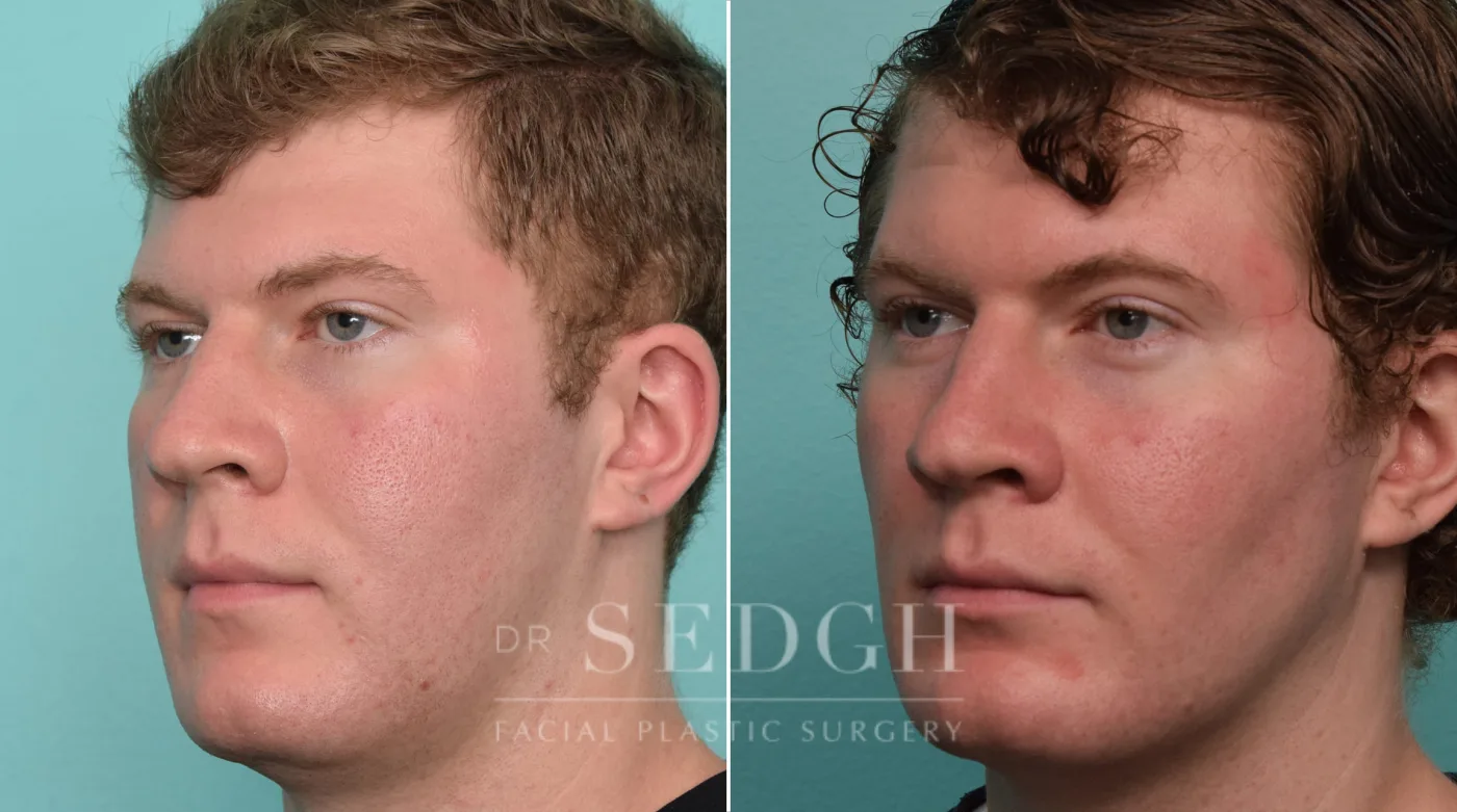 Patient 264 before Buccal Fat Reduction, view 1