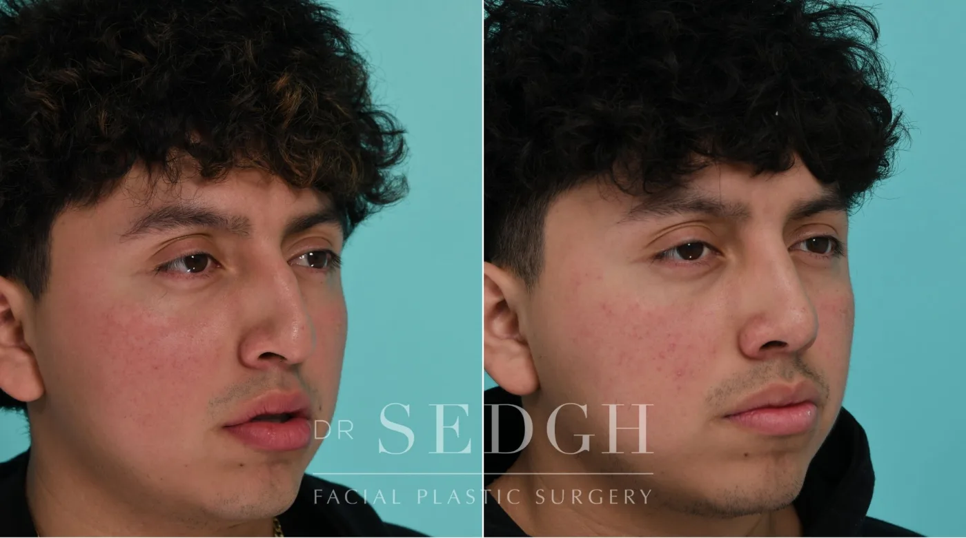 Patient 339 after Male Rhinoplasty, view 2