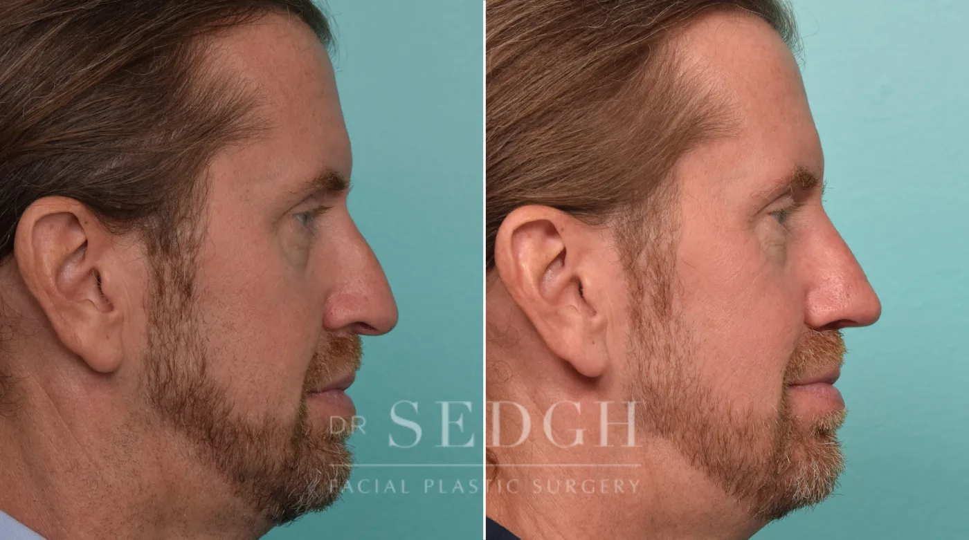 Patient 305 after Crooked Nose Surgery, view 1