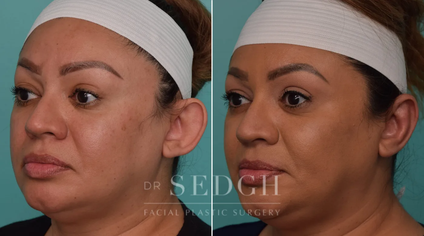 Patient 256 before Ear Pinning Surgery, view 1