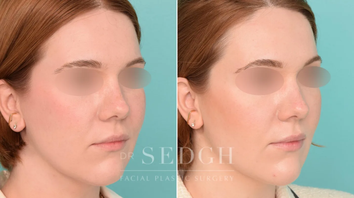 Patient 235 before Chin Filler, view 1