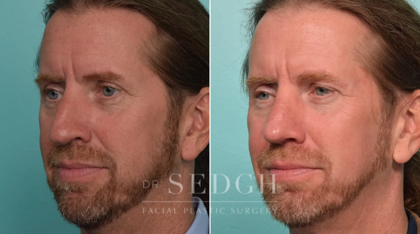 Patient 305 before Crooked Nose Surgery, view 2