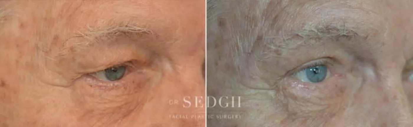 Patient 1 after Upper Blepharoplasty, view 1