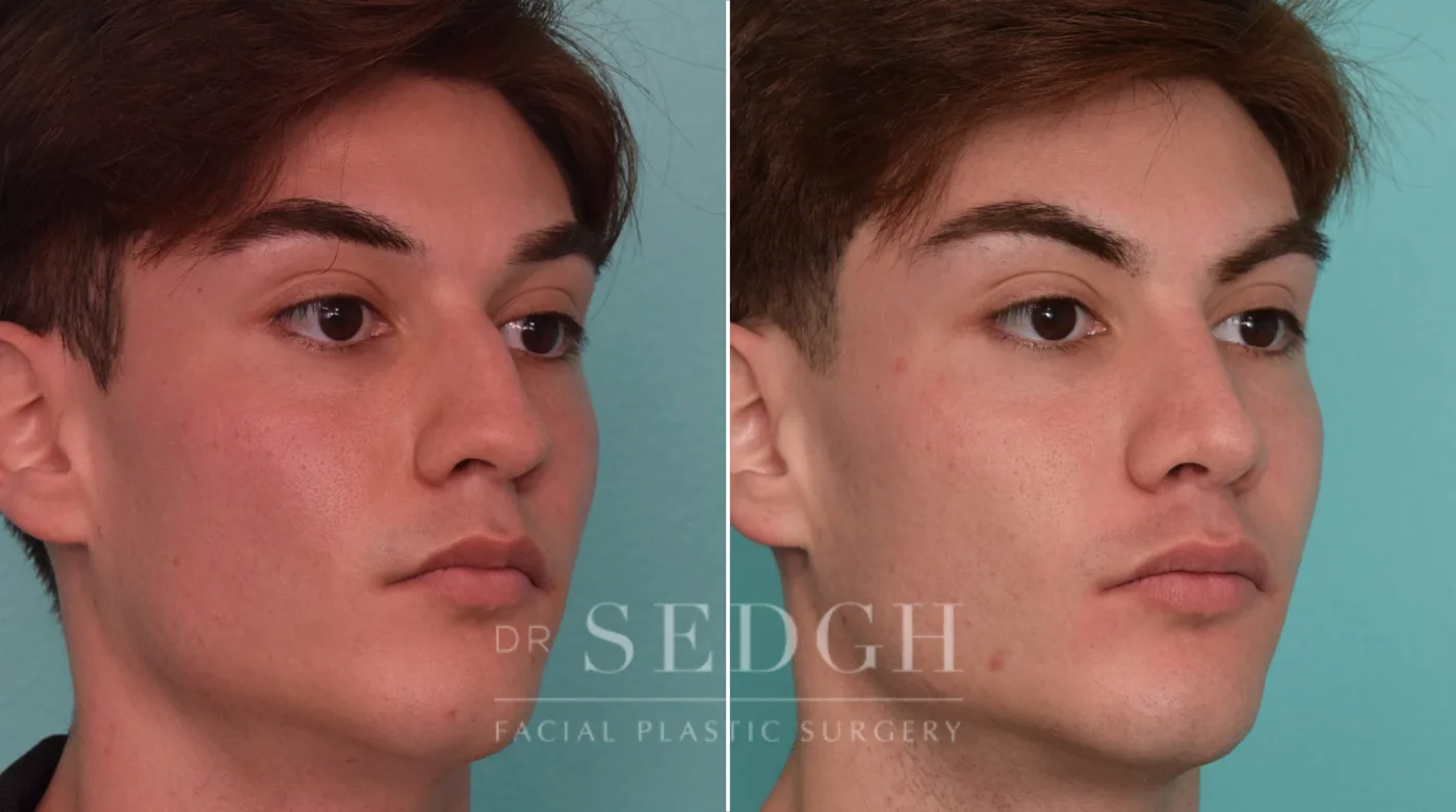 Patient 286 before Male Rhinoplasty, view 1
