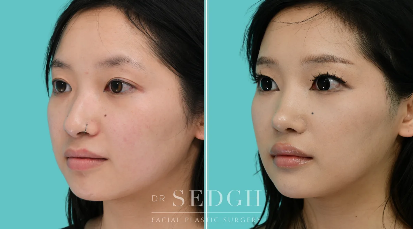 Patient 353 after Asian Rhinoplasty, view 3