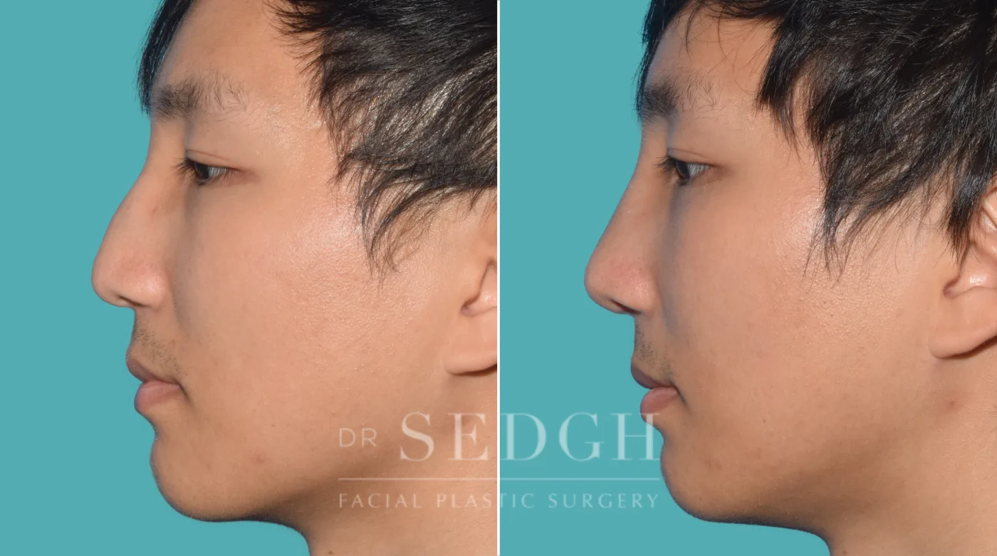 Patient 26 after Middle Eastern Rhinoplasty, view 2
