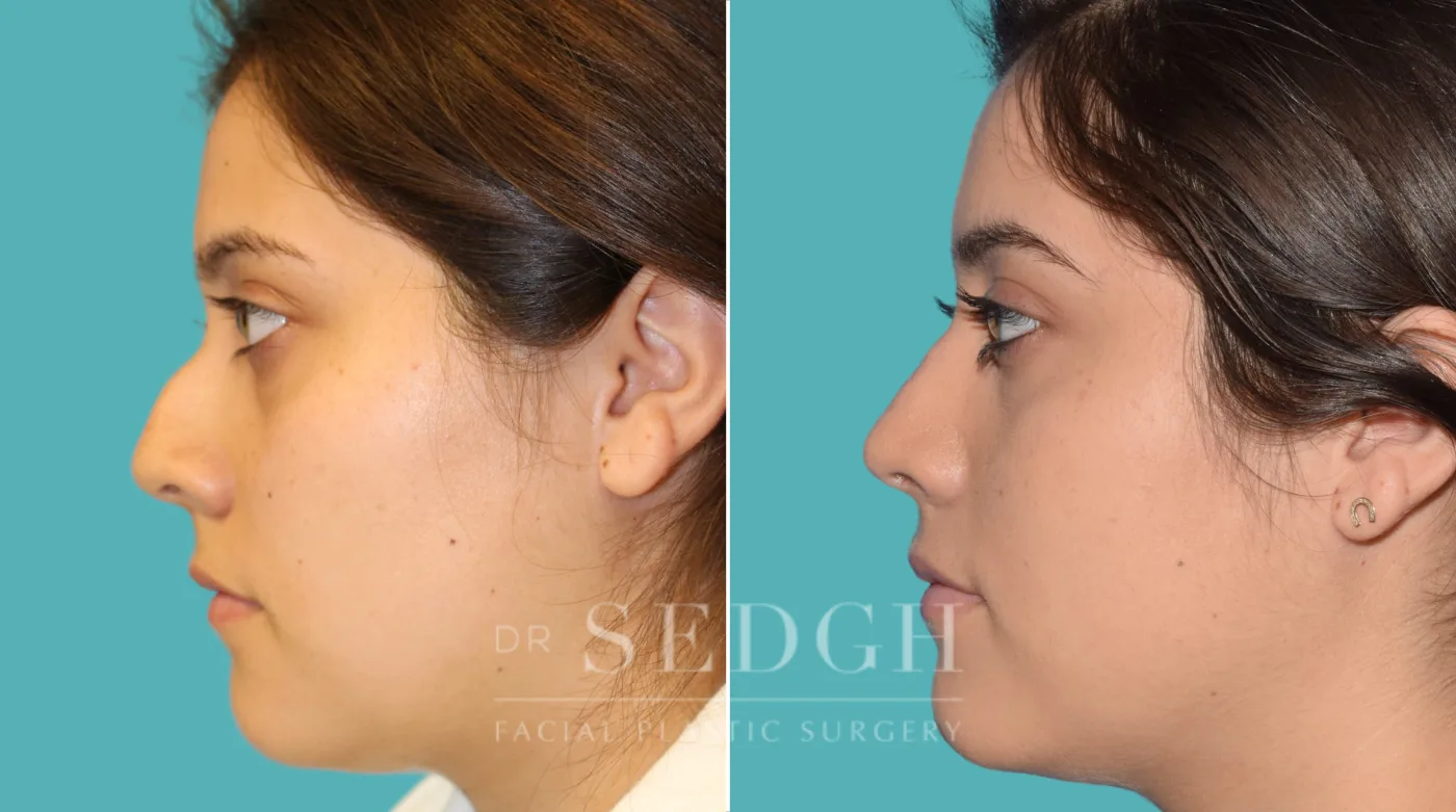 Patient 27 after Rhinoplasty, view 1