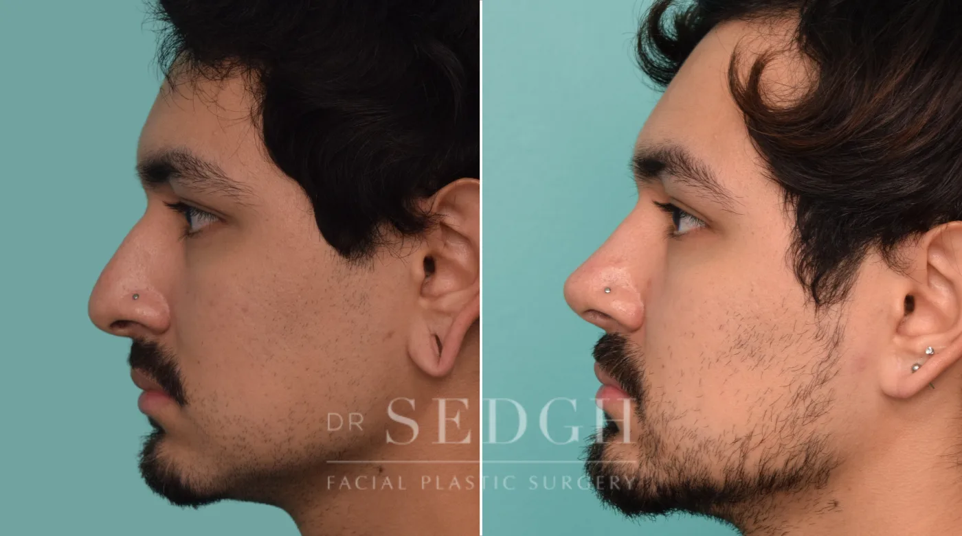 Patient 228 after Rhinoplasty, view 1