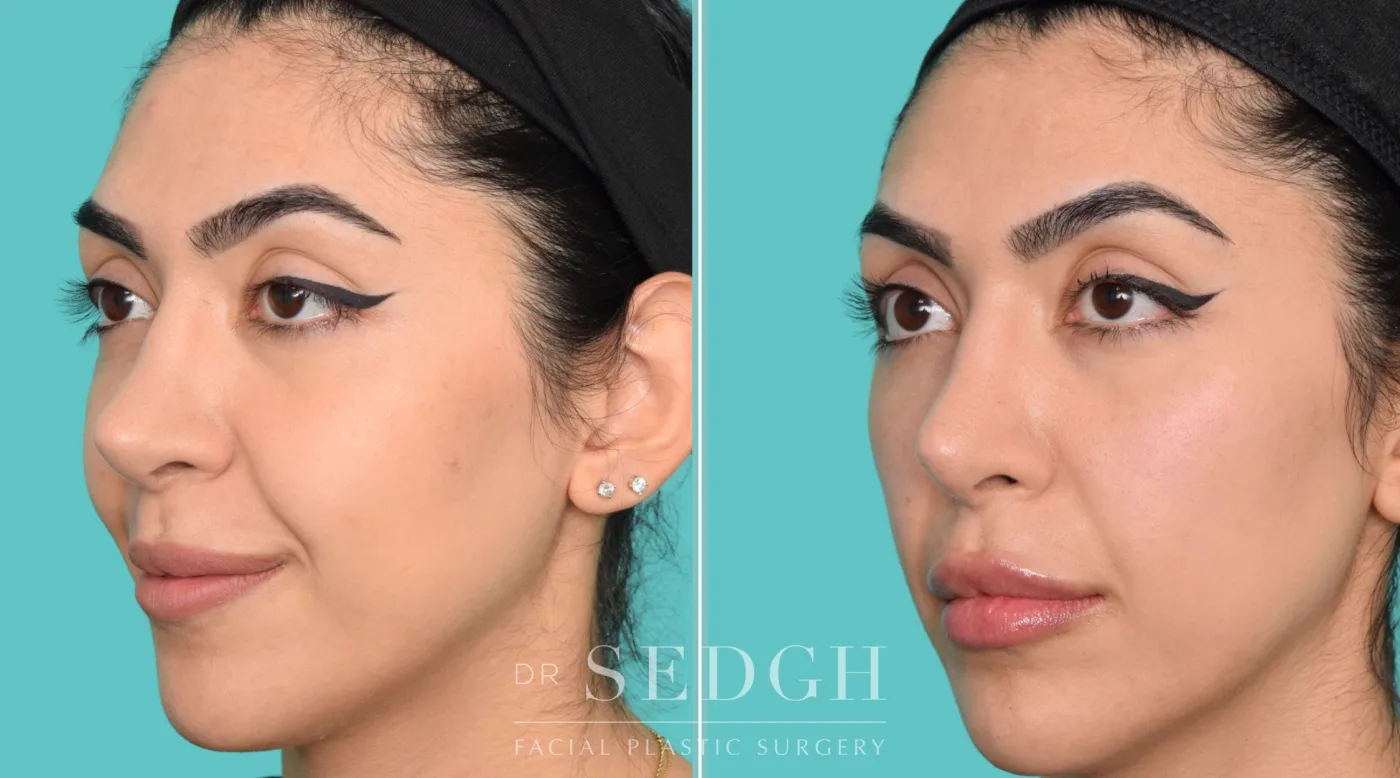 Patient 362 before Flat Helix Repair / Helical Reduction Otoplasty, view 1