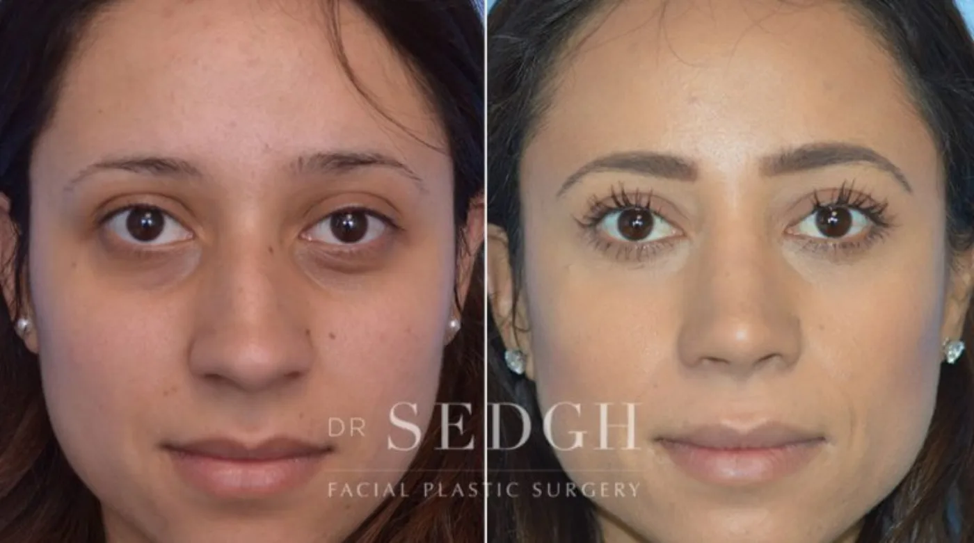 Patient 7 after Hispanic Rhinoplasty, view 1