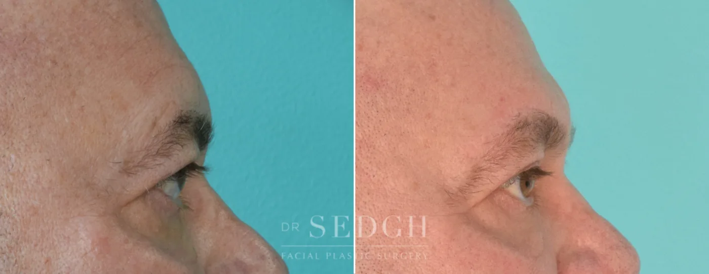Patient 205 after Upper Blepharoplasty, view 1