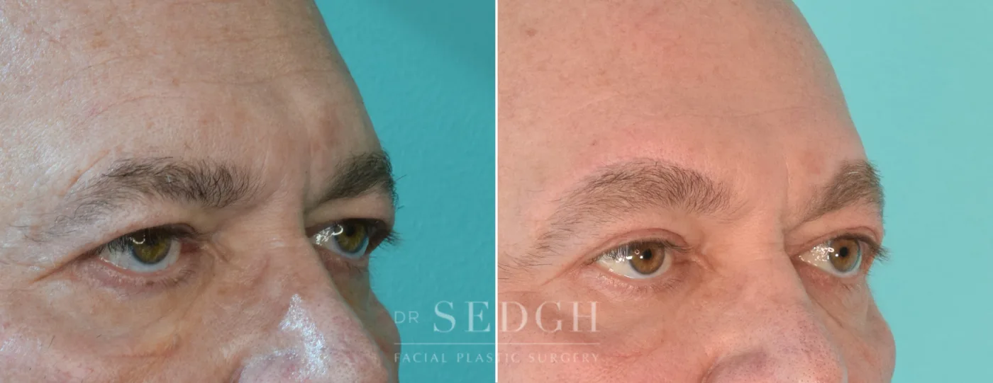 Patient 205 before Upper Blepharoplasty, view 1