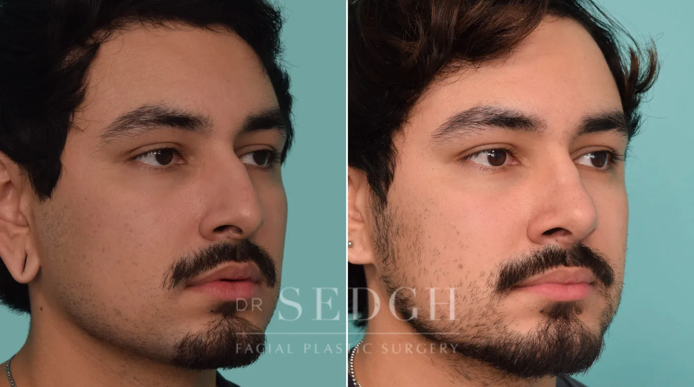 Patient 228 before Rhinoplasty, view 2