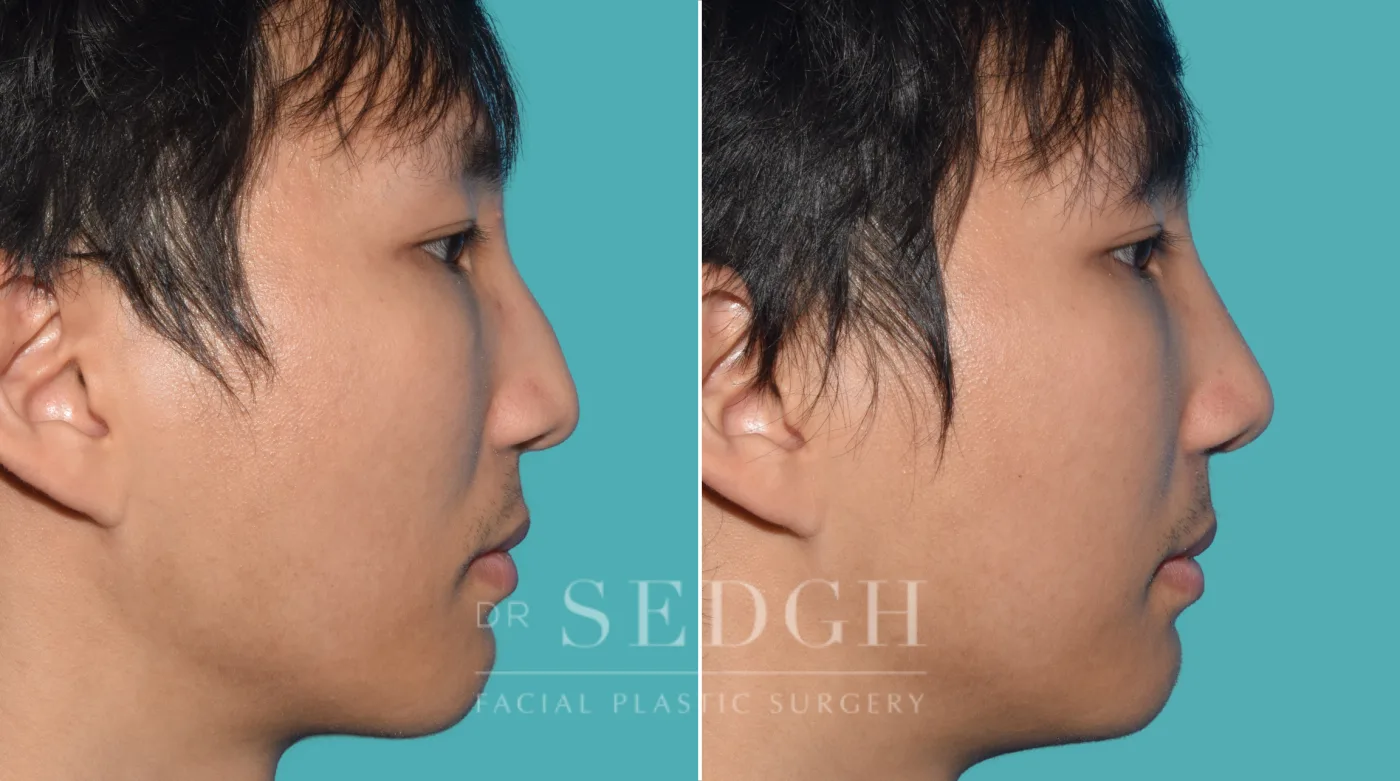 Patient 26 after Middle Eastern Rhinoplasty, view 1