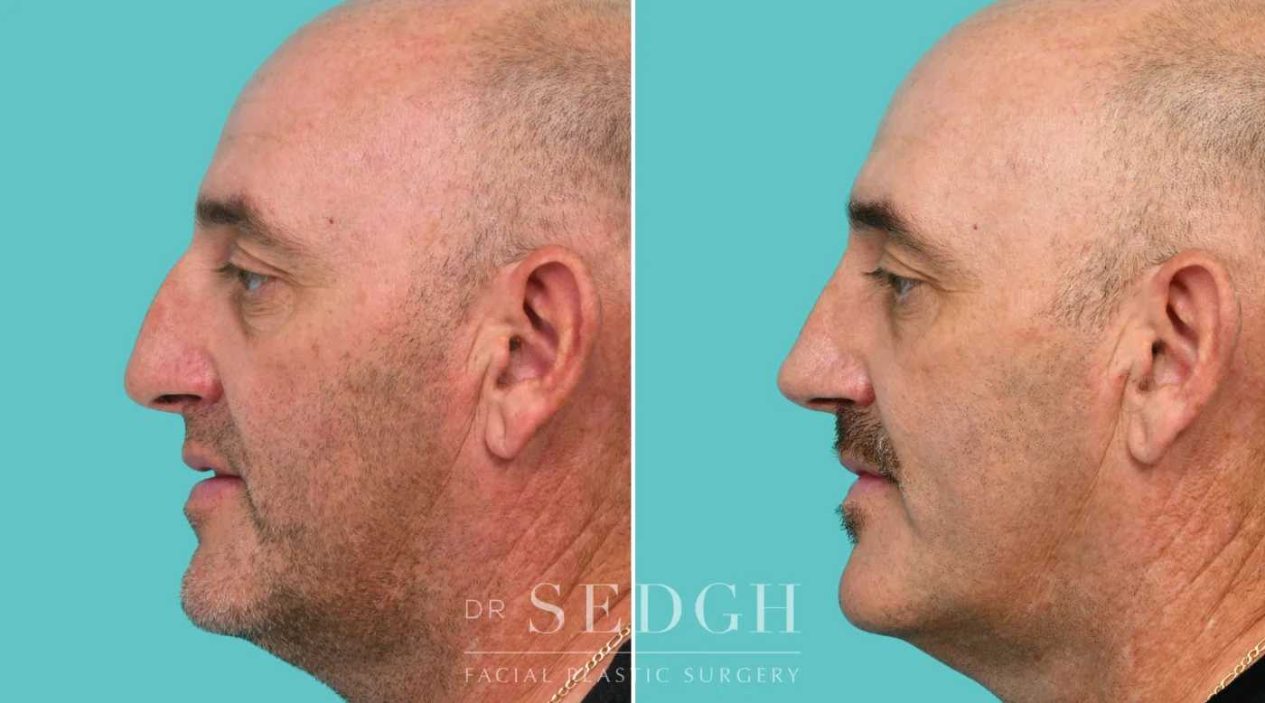 Patient 343 after Crooked Nose Surgery, view 3