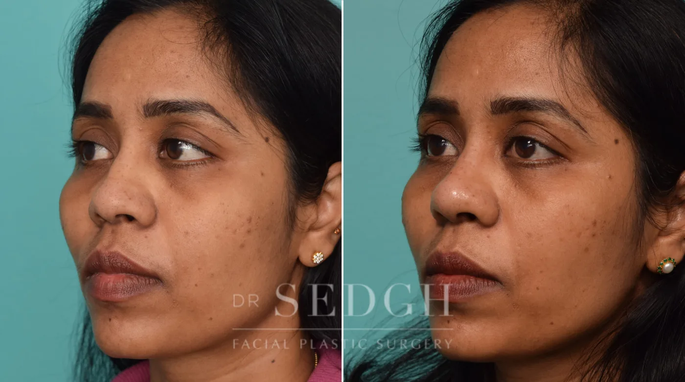 Patient 219 before Liquid Rhinoplasty, view 1