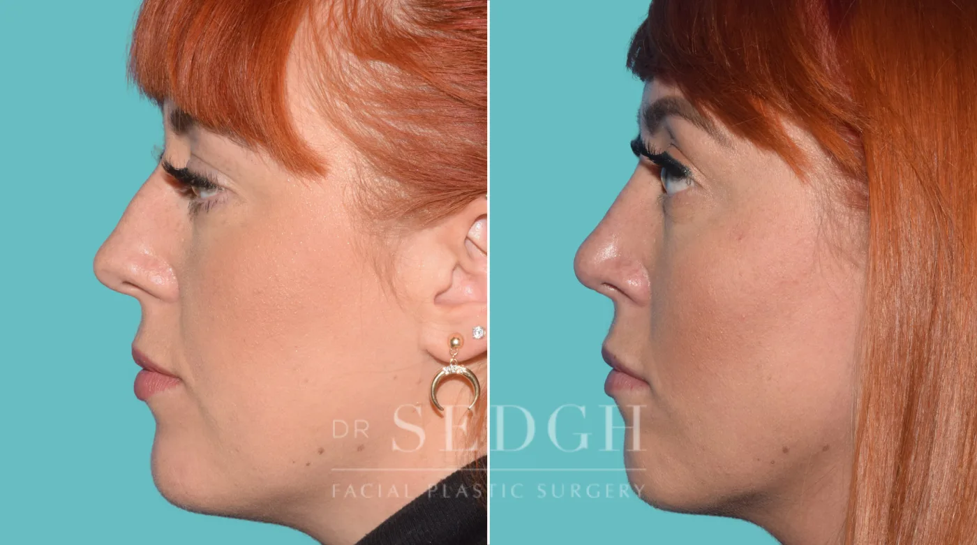 Patient 38 after Facial Fillers, view 2