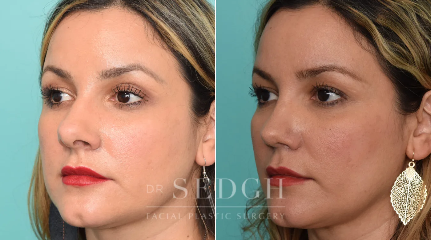 Patient 260 before Rhinoplasty, view 1