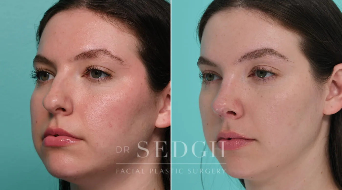Patient 326 before Rhinoplasty, view 1