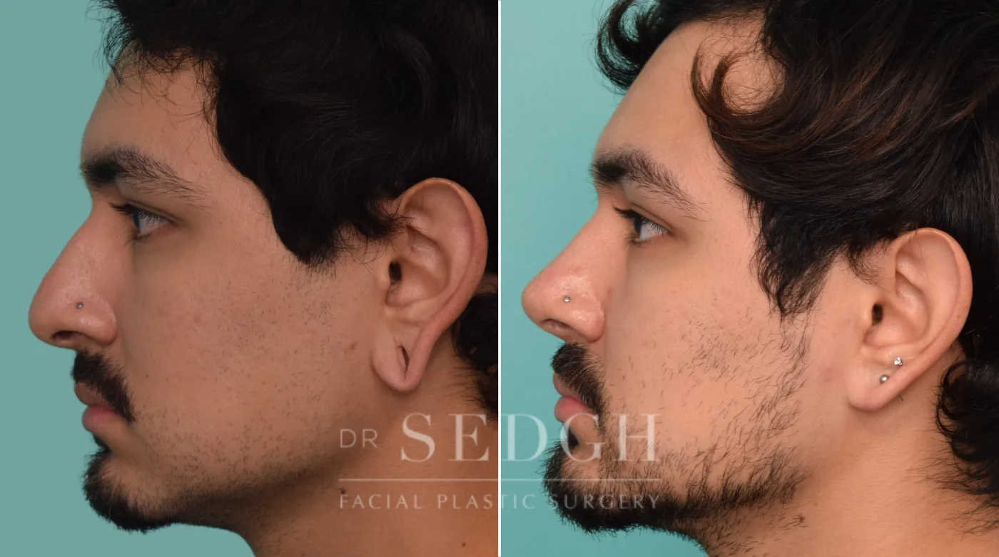 Patient 228 after Ear Lobe Repair, view 1