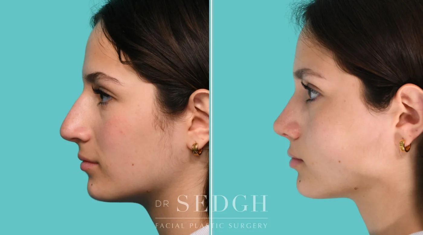 Patient 350 after Middle Eastern Rhinoplasty, view 2