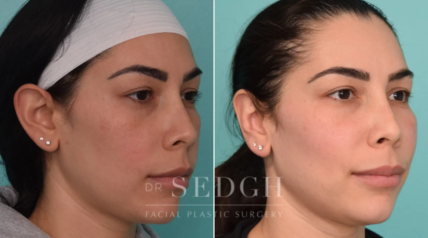 Patient 258 before Ear Pinning Surgery, view 2
