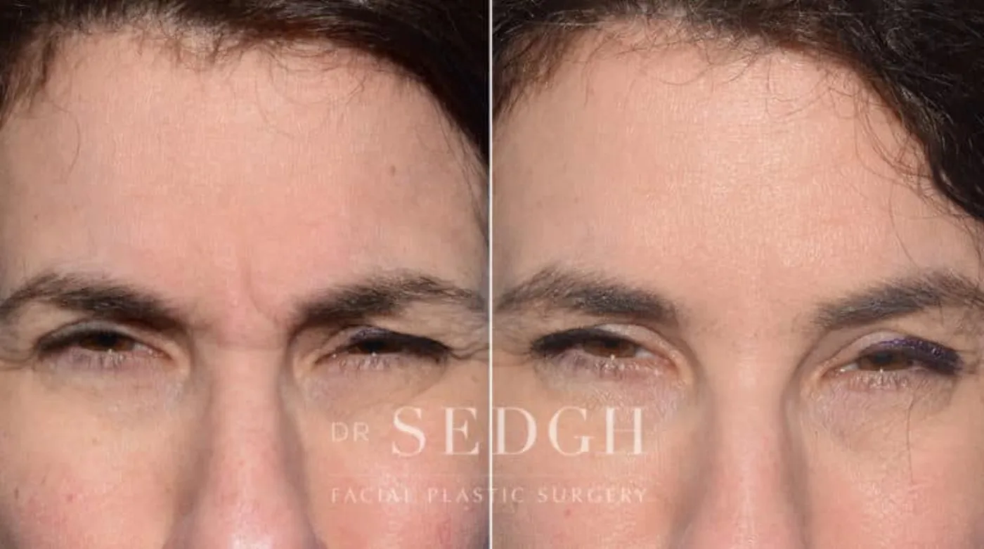 Patient 9 after Wrinkle Relaxers, view 1
