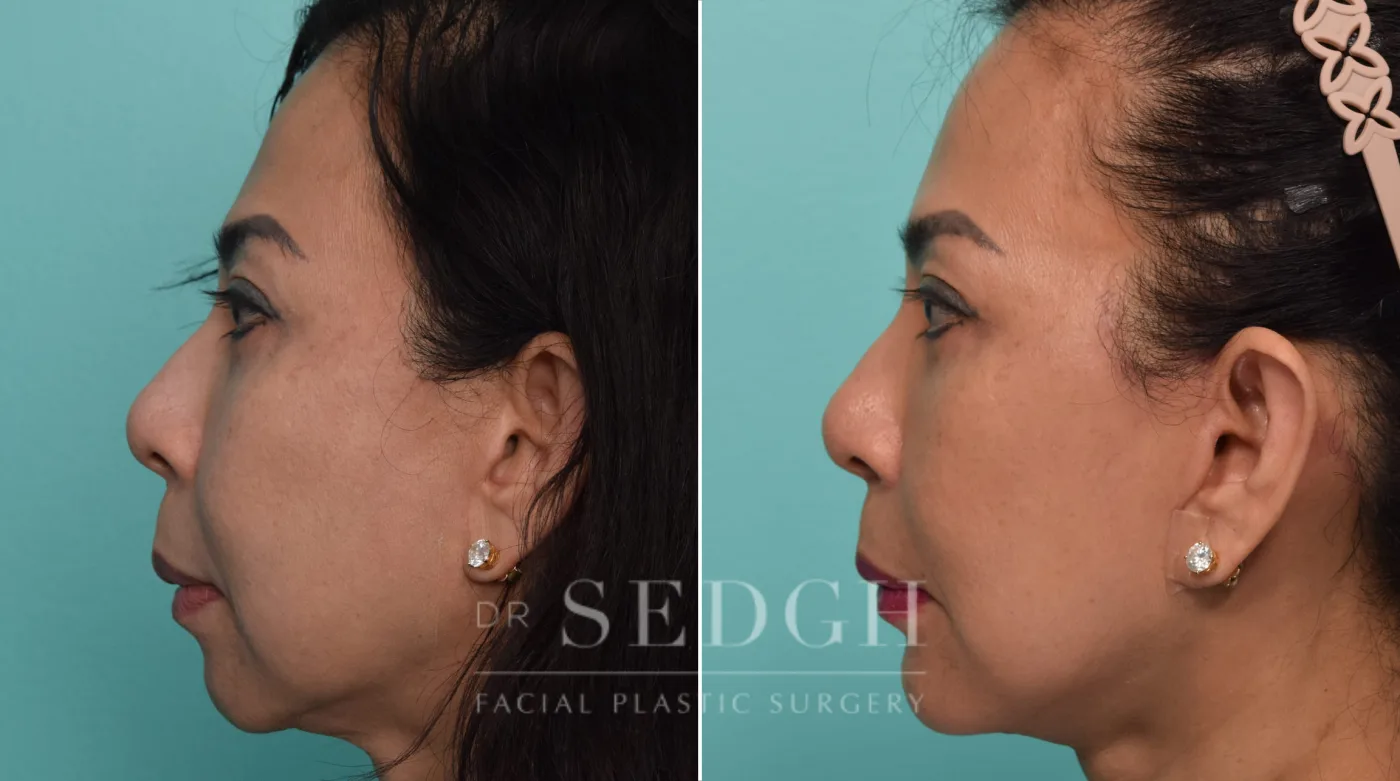 Patient 291 after Face Lift, view 2