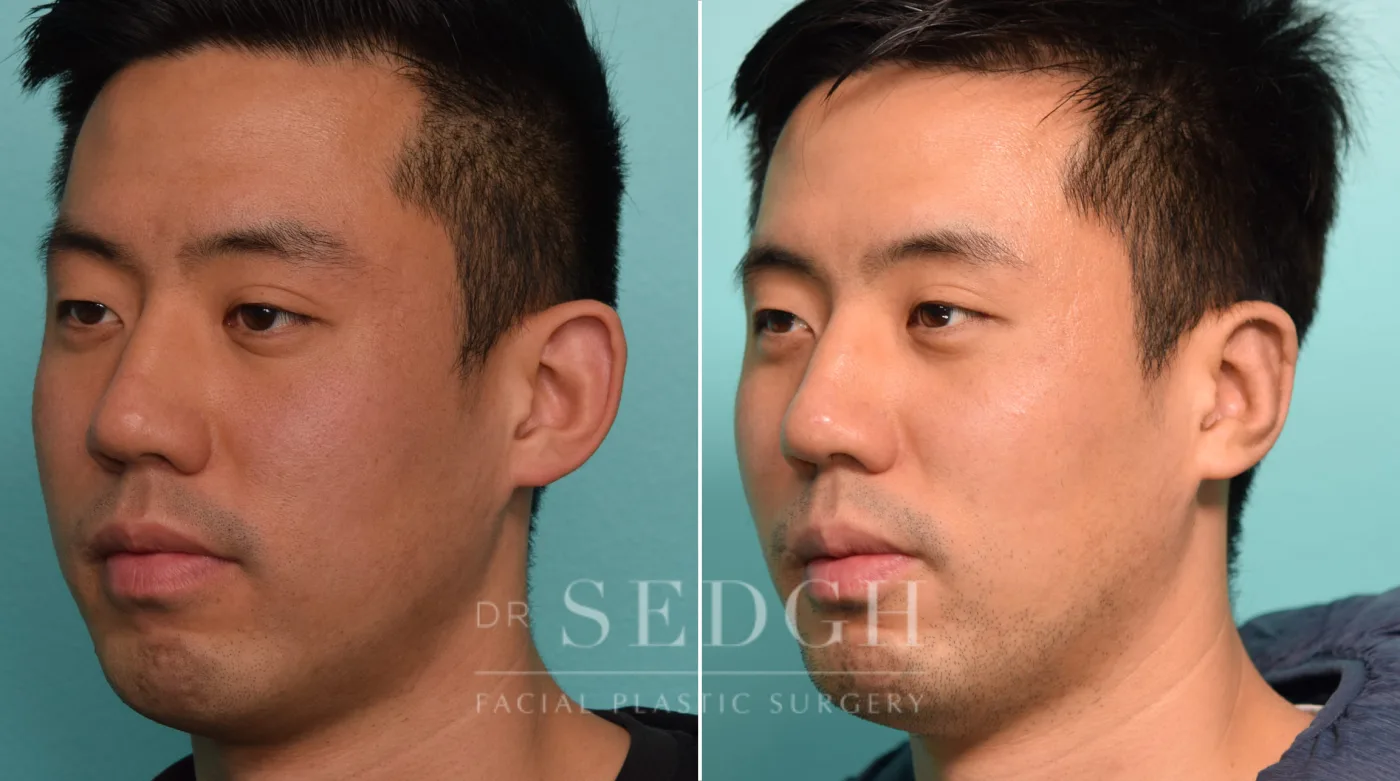 Patient 265 before Ear Pinning Surgery, view 1