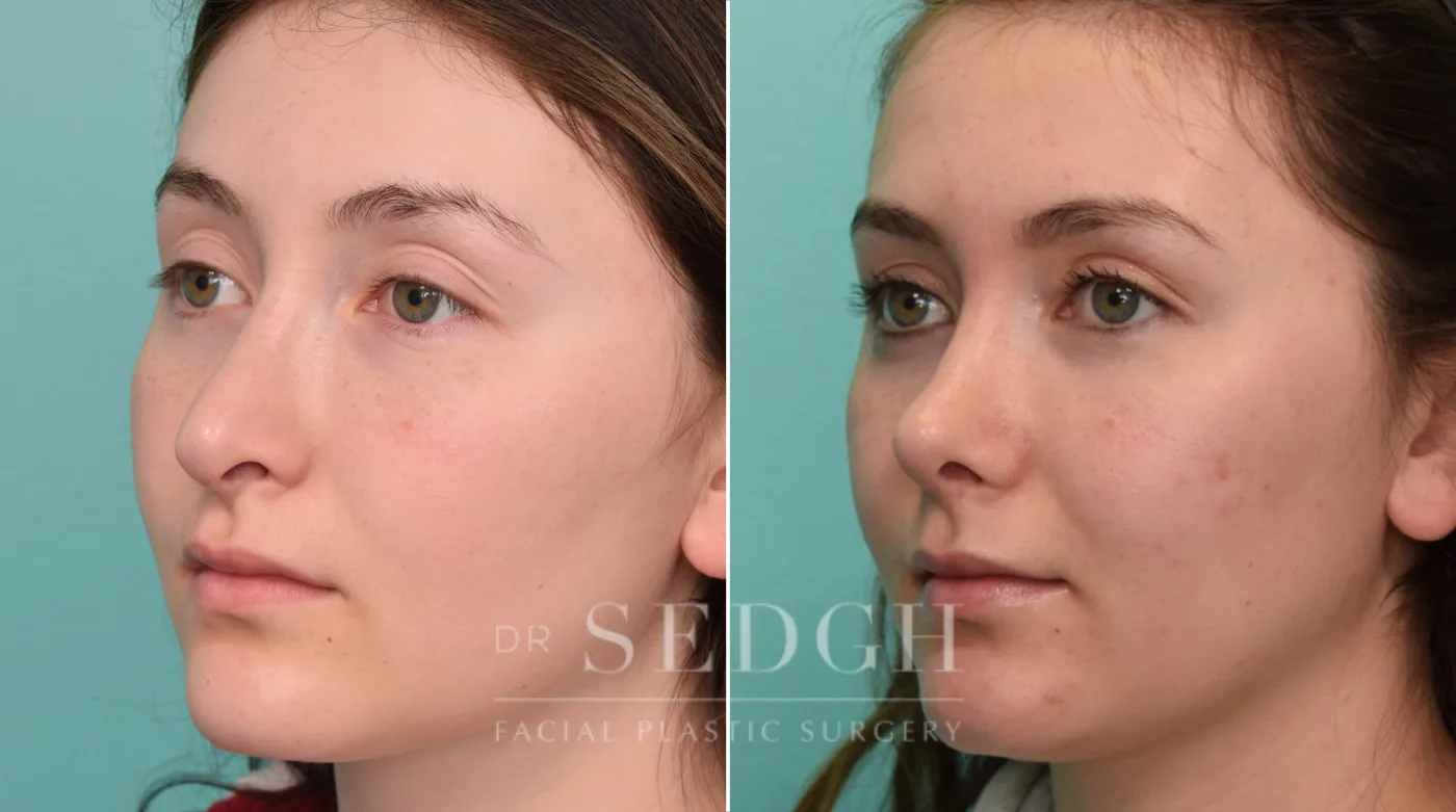 Patient 328 before Revision Rhinoplasty, view 2