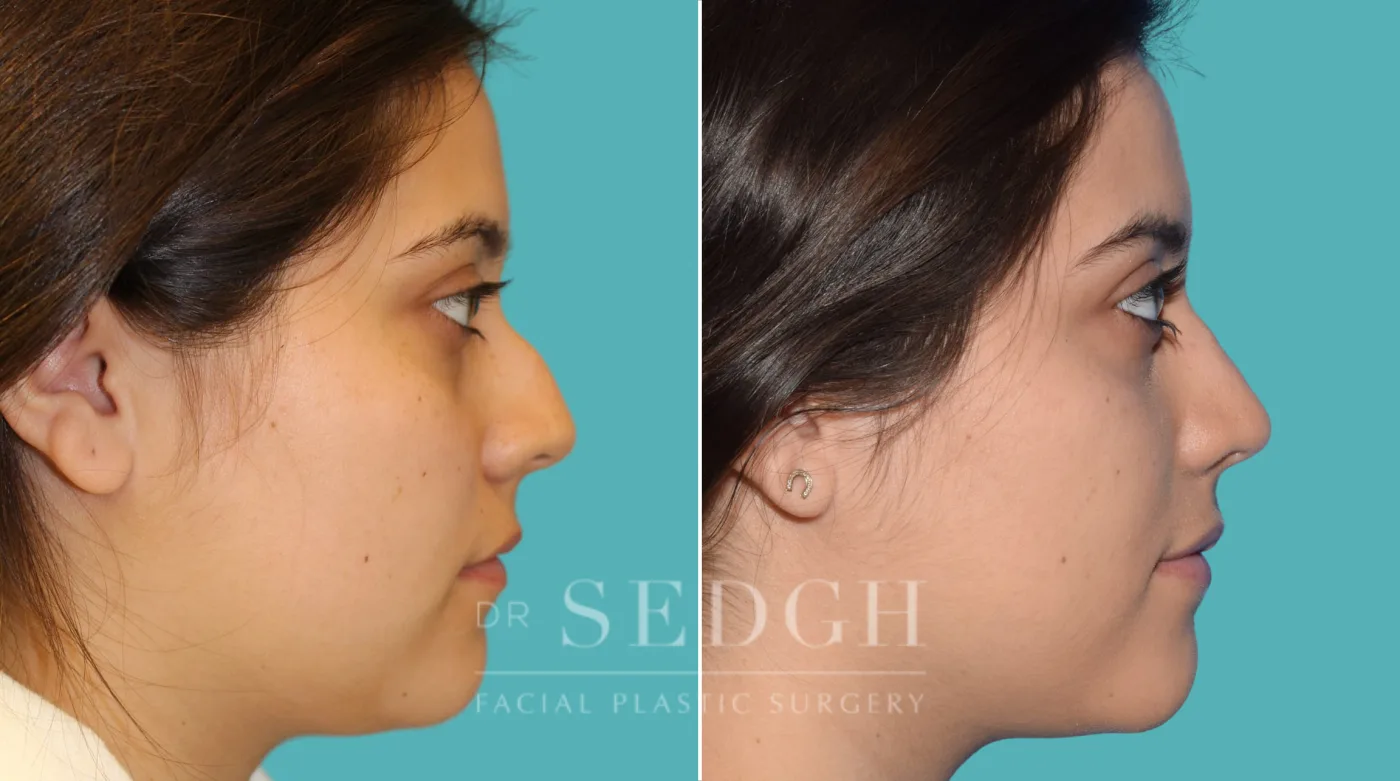Patient 27 after Rhinoplasty, view 2