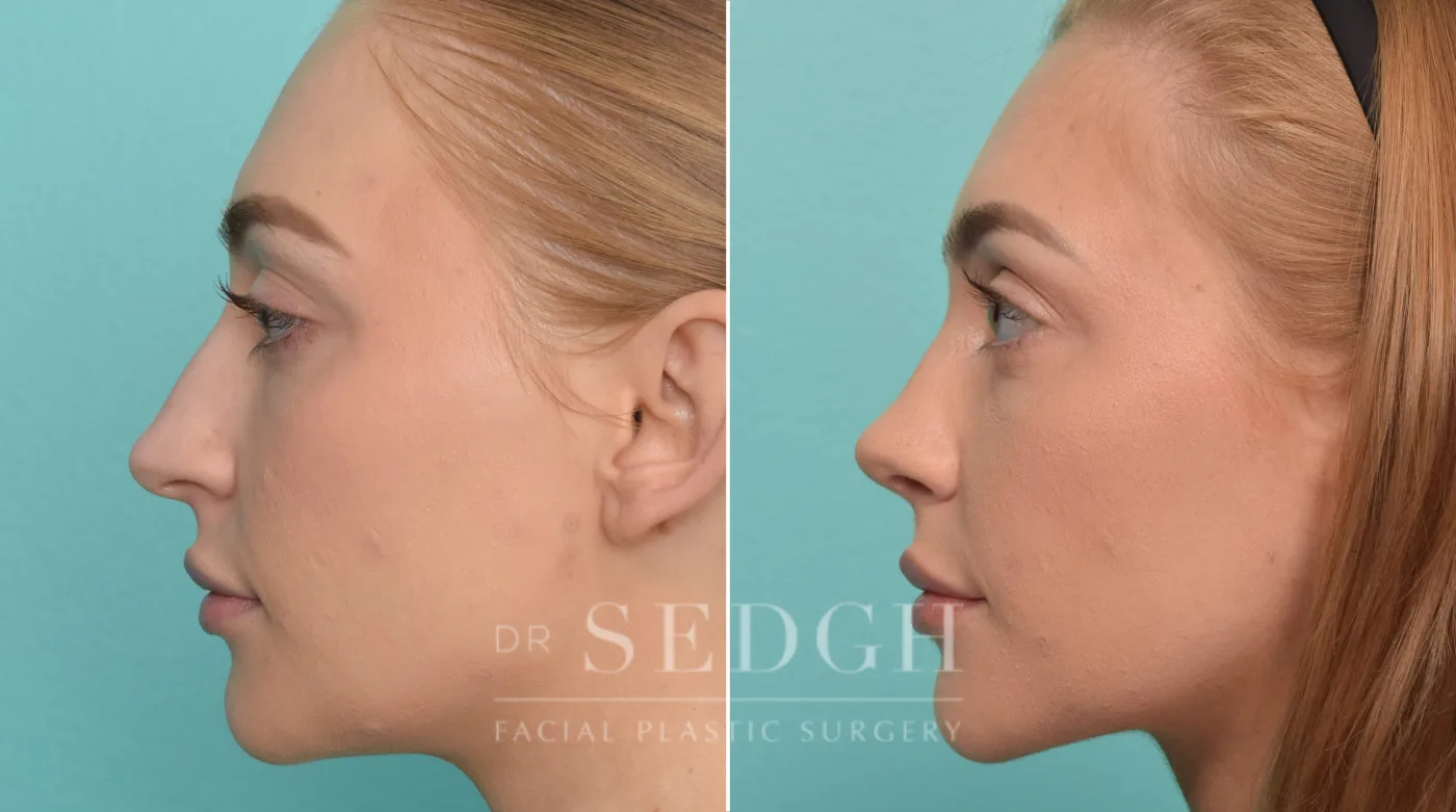 Patient 298 after Rhinoplasty, view 2