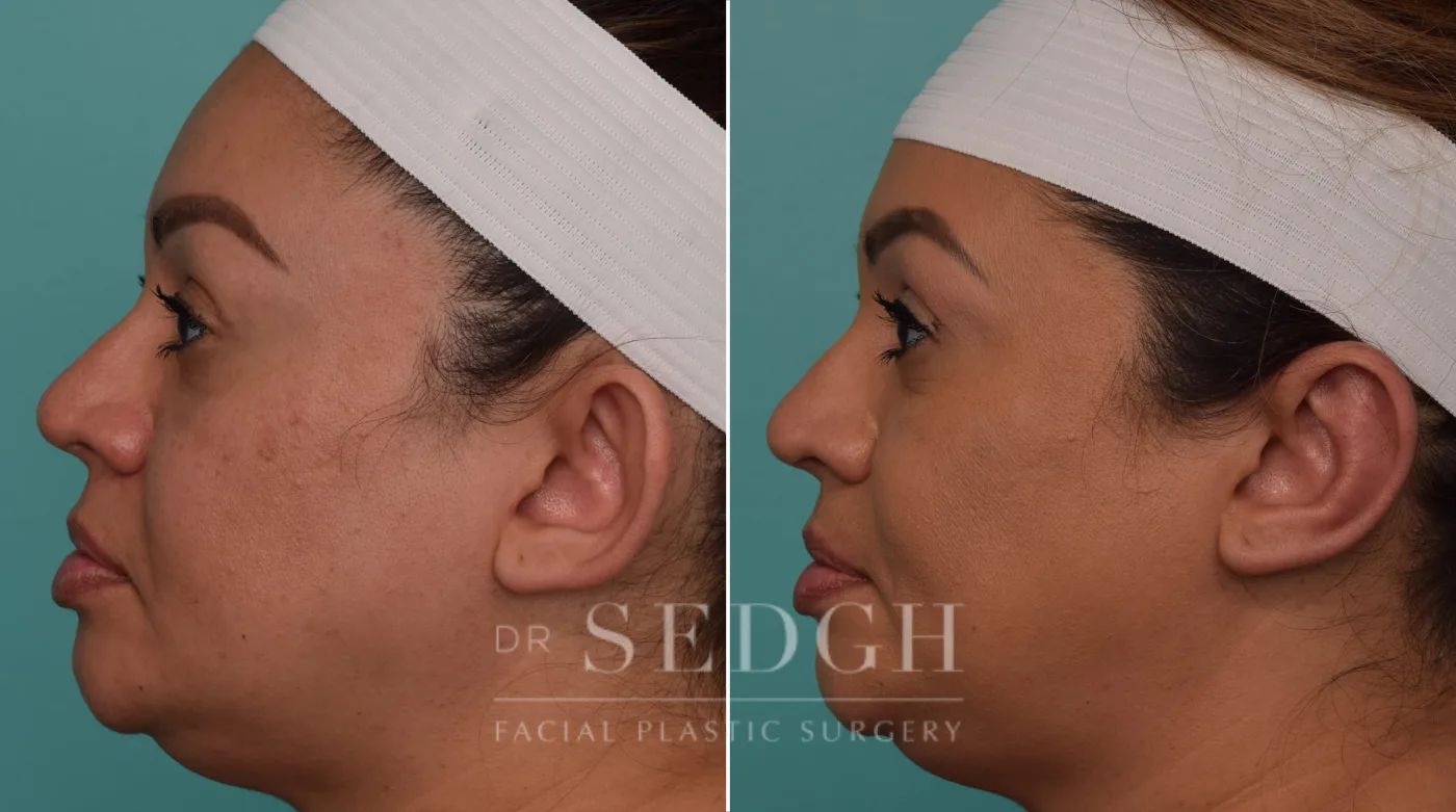 Patient 256 after Ear Pinning Surgery, view 1