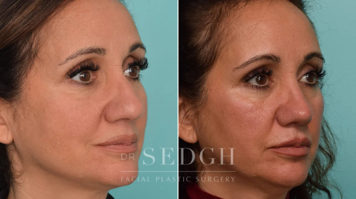 Patient 275 before Middle Eastern Rhinoplasty, view 1