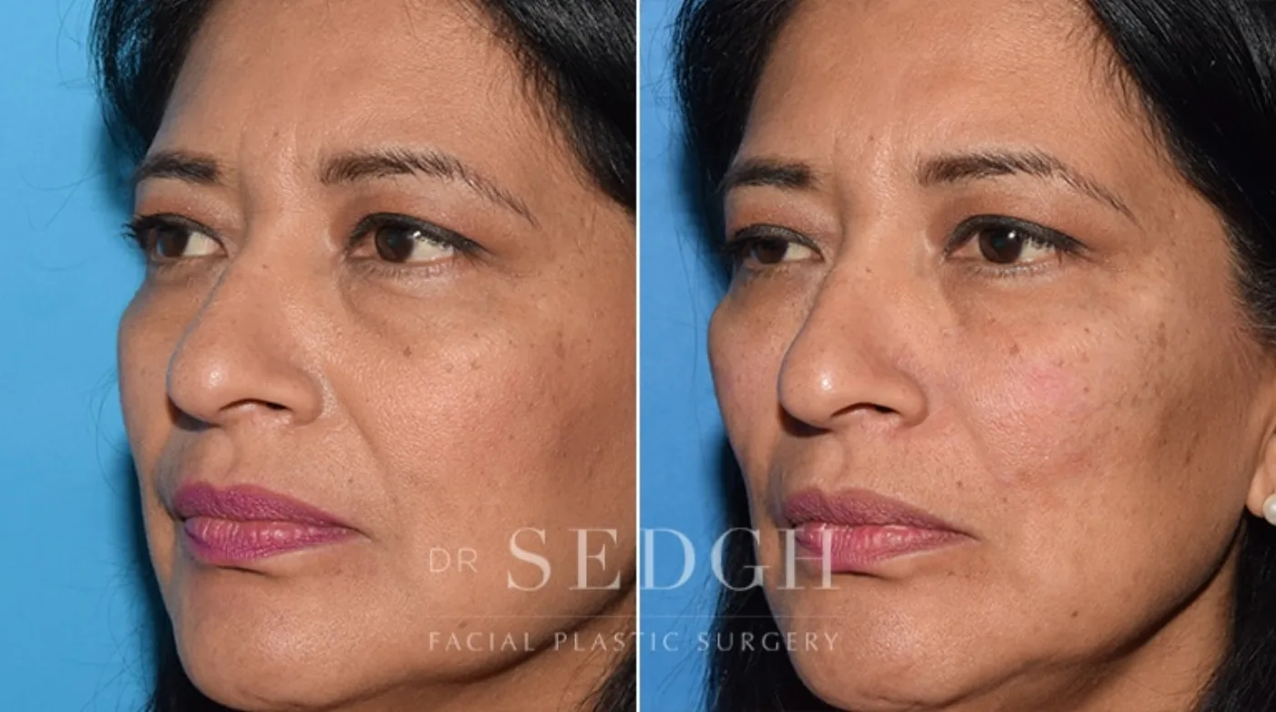 Patient 12 after Facial Fillers, view 1