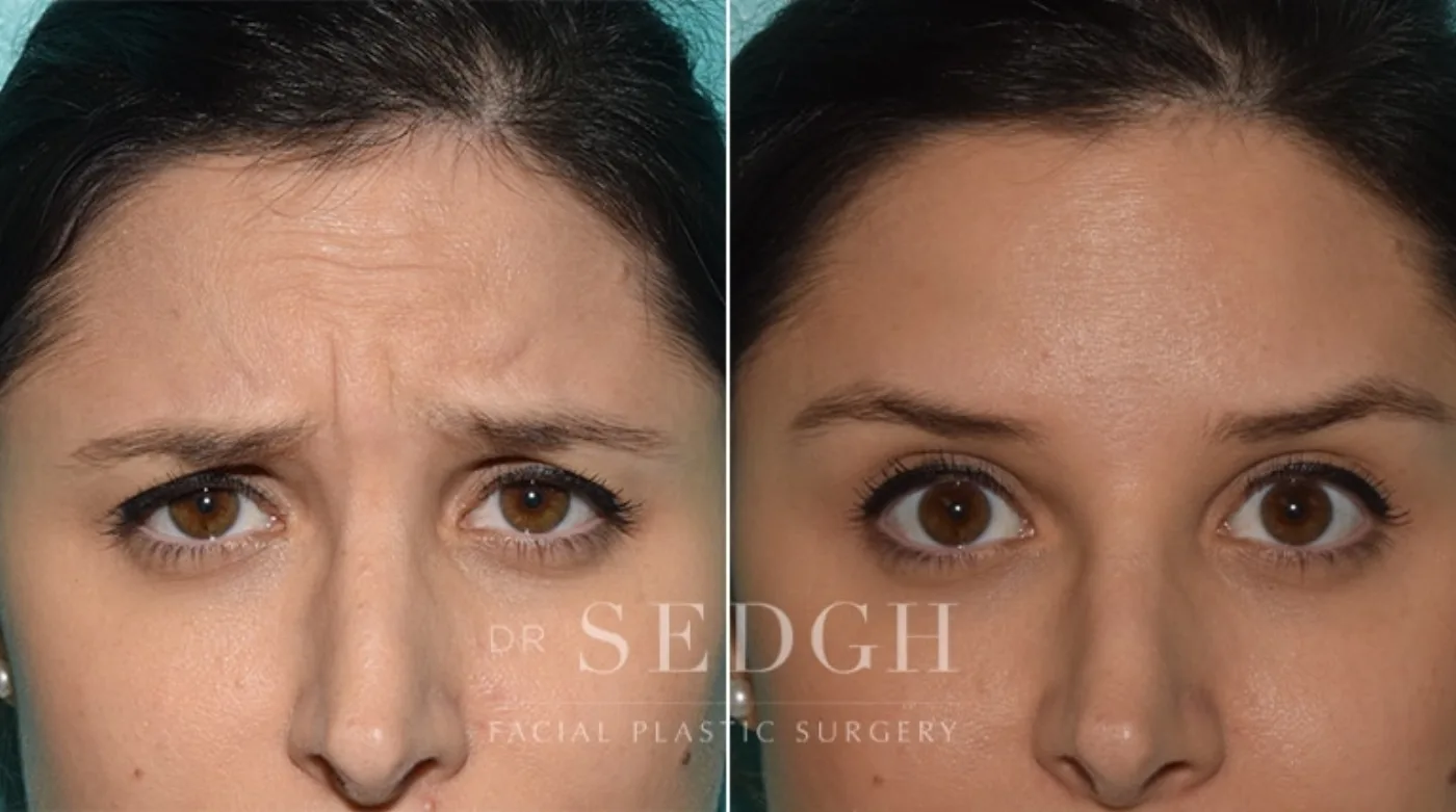 Patient 1 before Wrinkle Relaxers, view 1
