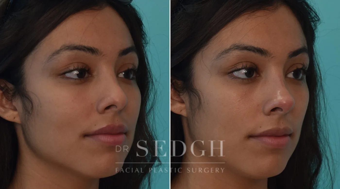 Patient 192 before Facial Fillers, view 1