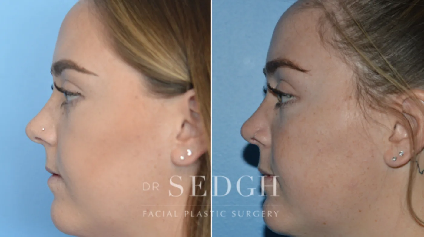 Patient 14 after Crooked Nose Surgery, view 2