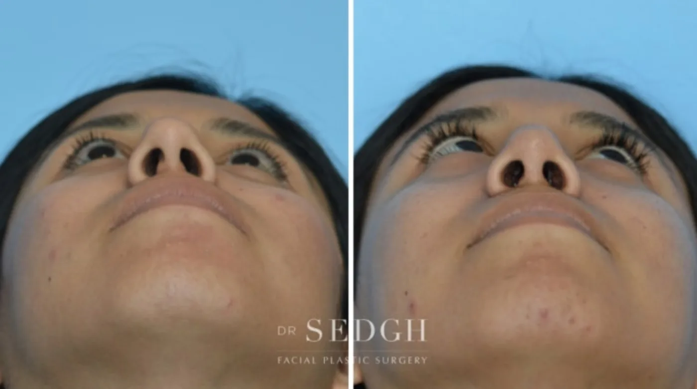 Patient 11 before Hispanic Rhinoplasty, view 1
