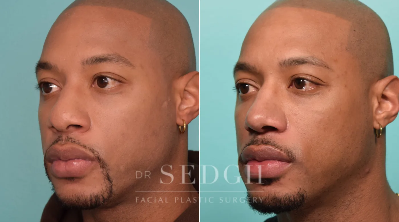 Patient 22 before Male Rhinoplasty, view 1