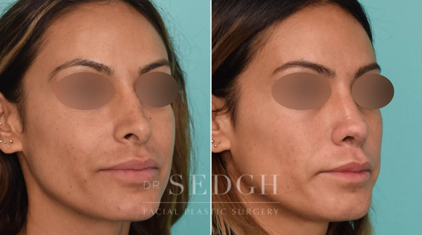 Patient 259 before Revision Rhinoplasty, view 1