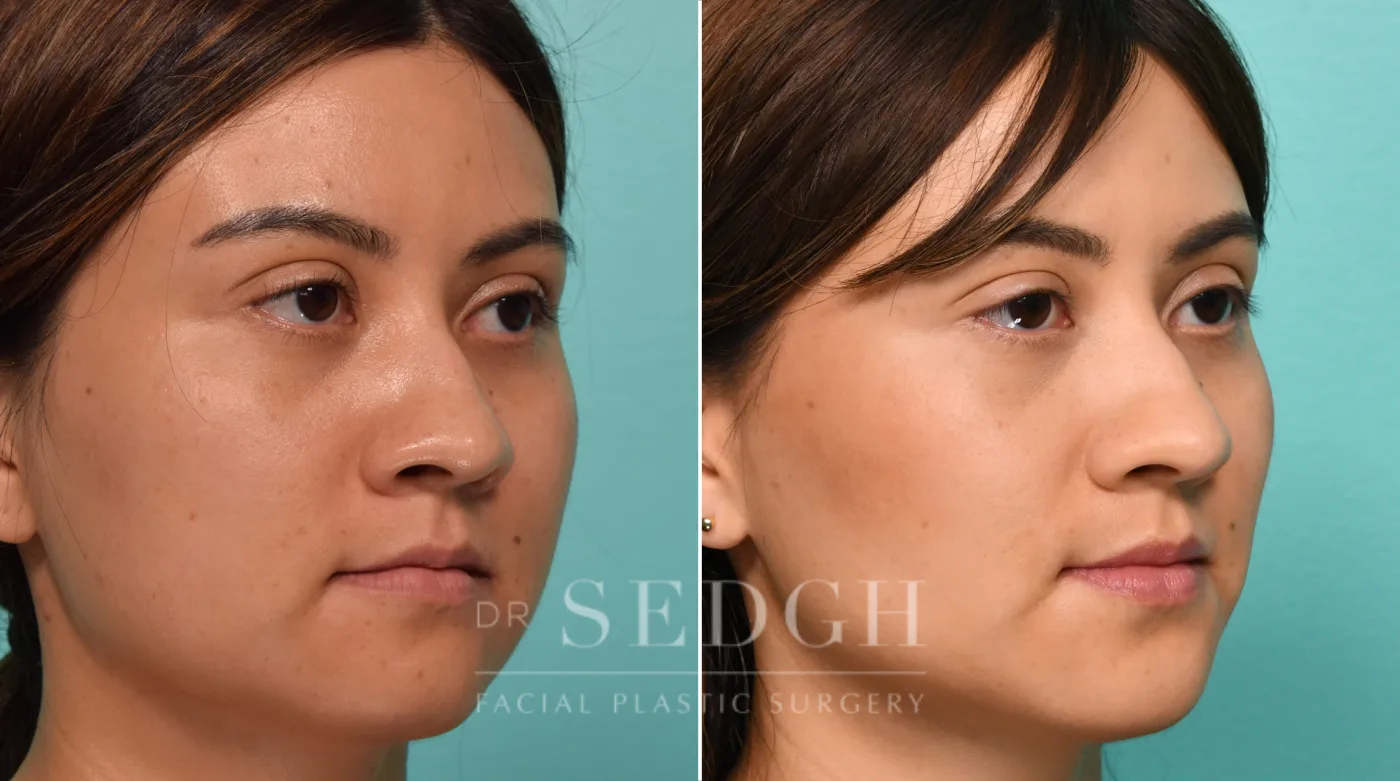 Patient 307 before Buccal Fat Reduction, view 1