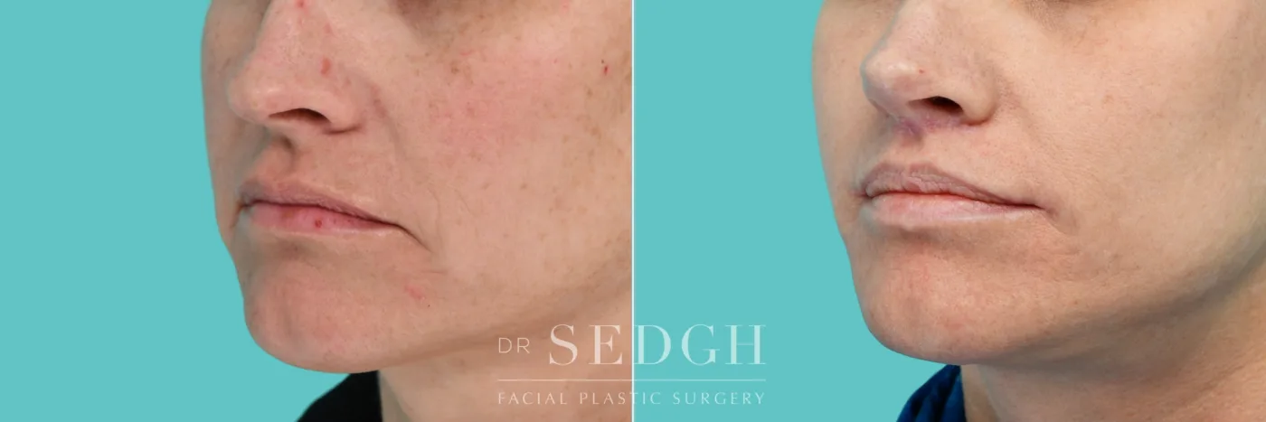 Patient 352 before Lip Lift, view 1