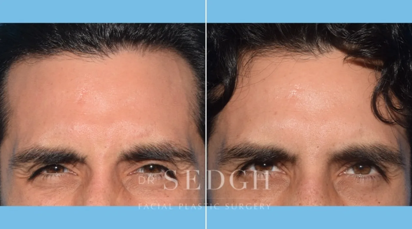 Patient 2 after Wrinkle Relaxers, view 1