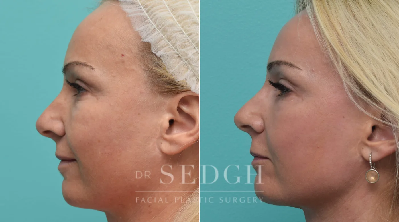 Patient 150 after Laser Skin Treatments, view 1
