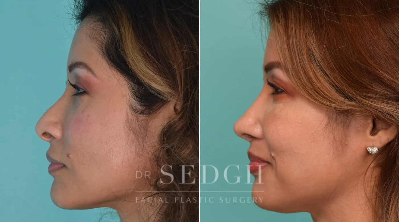 Patient 207 after Revision Rhinoplasty, view 1